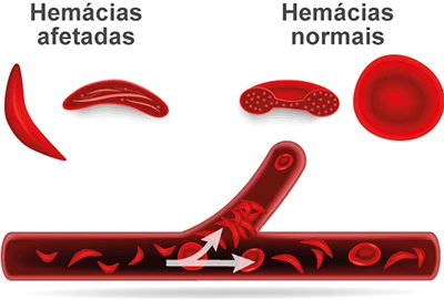 Ilustração - Anemia Falciforme