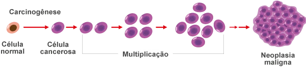 Ilustração - Neuroblastoma