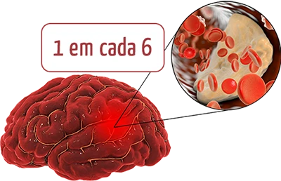 Ilustração informativa de cérebro afetado por AVC