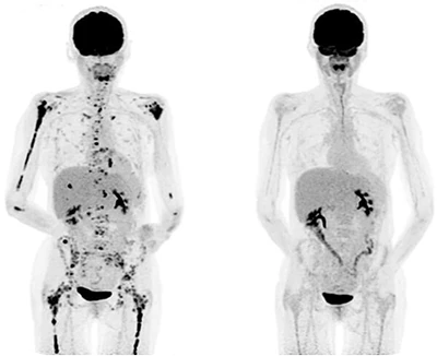 PET scans de um paciente com mieloma múltiplo tratados com células CAR-T. Antes do tratamento (à esquerda) e após (à direita).